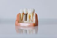Smart Care for Dental Implants: A Guide to Fresh Breath, Regular Check-Ups, and Thoughtful Eating