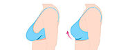 Breast Lift vs. Implants: Which Procedure is Right for Me?