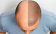 Which is the Best Hair Transplant Clinic in India?