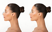 Who is the Best Rhinoplasty Surgeon in India?