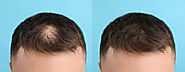 Why PRP is Important After Hair Transplant?