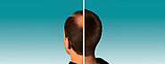 Things To Know Before Going for a Hair Transplant Surgery