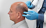Hair Transplant Cost in Different Cities in India