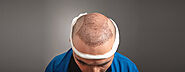 Cost of a Hair Transplant in India: What You Need to Know