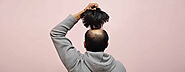Which is the Better Treatment Hair- Transplant or Hair Wig?