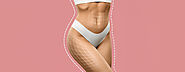 The Truth About Liposuction & Body Contouring No One Tells You