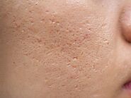 Home Remedies for Acne Scars: What Works and What Doesn't
