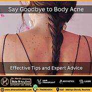 Say Goodbye to Body Acne: Effective Tips and Expert Advice - Dermatologist in Roorkee