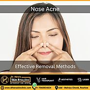 Nose Acne: Effective Removal Methods - Dermatologist in Roorkee