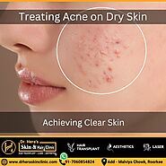 Achieving Clear Skin: Treating Acne on Dry Skin - Dermatologist in Roorkee