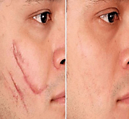 Facial Scar Evacuation Utilizing Silicone Scar Sheets
