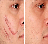 Treatments and Procedures: Facial Scar Revision