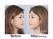 How much does nose reshaping surgery cost - rhinoplasty costs