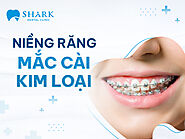 Niềng răng mắc cài kim loại và những điều bạn cần biết