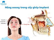 Nâng xoang trong cấy ghép Implant - Hiểu đúng áp dụng AN TOÀN