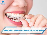 Niềng răng trong suốt Invisalign giá bao nhiêu? Có đắt không