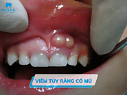 Viêm tủy răng có mủ - Nguyên nhân và cách khắc phục hiệu quả