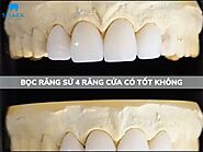 Bọc răng sứ 4 răng cửa có tốt không và lý do vì sao?