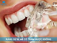 Răng sứ bị mẻ có trám được không? Nên áp dụng như thế nào?