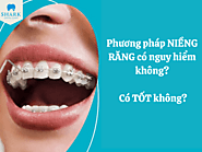 Phương pháp niềng răng có nguy hiểm không? Có tốt không?