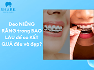 Đeo niềng răng trong bao lâu để có kết quả đều và đẹp?