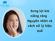 Sưng lợi khi niềng răng - Nguyên nhân và cách xử lý hiệu quả