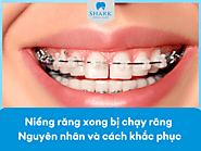 Niềng răng xong bị chạy răng – Nguyên nhân và cách khắc phục 