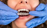 Embraces The Future of Orthodontics With Invisalign Aligners Lafayette