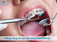 Niềng răng có cạo vôi răng được không? Cần lưu ý những gì?