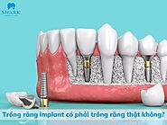 Trồng răng Implant có phải trồng răng thật không? Vì sao?