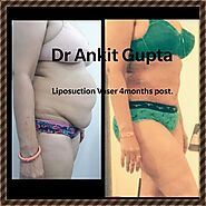 Liposuction Surgery results