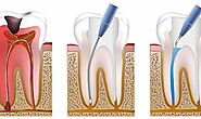 : Why Root Canal Therapy in Magnolia is The Best Solution for Dental Issues