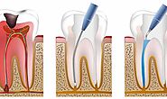 Beyond Pain: Navigating Root Canal Therapy in Magnolia