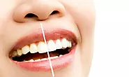 Teeth Whitening: How to Get a Brighter Smile in Just One Session?