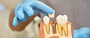 Beverly Hills Dental Implants Experts Offer A Second Chance At Smiles
