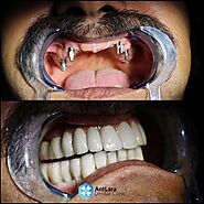 All-On-4 Dental Implants (All On Four Implants Turkey) - Antlara Dental