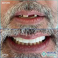 Zirconia Crowns Treatment - Medical Dental Turkey