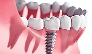 Say Goodbye To Gaps: Unveiling The Secret To A Perfect Smile with Dental Implants in Puyallup