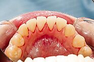Gum Disease Treatment in Houston, TX | University Periodontal Associates