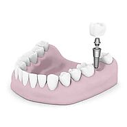 Dental Implants in Houston, TX | University Periodontal Associates