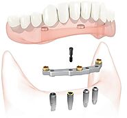 Implant Dentures | Implant Dentist Houston, TX | University Periodontal Associates