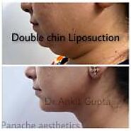 Double Chin Liposuction Review by Dr Ankit Gupta
