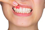 Teeth Infections: Infected Wisdom Tooth - Teeth Infection