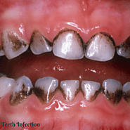 Website at https://teethinfection.com/black-plaque-on-teeth/