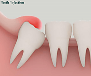 Pericoronitis Treatment At Home - Teeth Infection