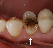 Root Canal Cracked Tooth - Teeth Infection
