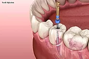 Recovery from root canal treatment - Teeth Infection