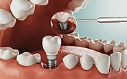 Dental Implants: Walkthrough Of The Dental Procedure? - News Ethnic