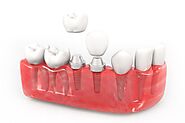 Dental Implants: Everything You Need To Know About - Join Articles