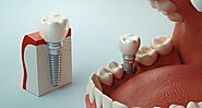 All About A Dental Implant - News Towns